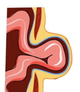 Hernia Surgery